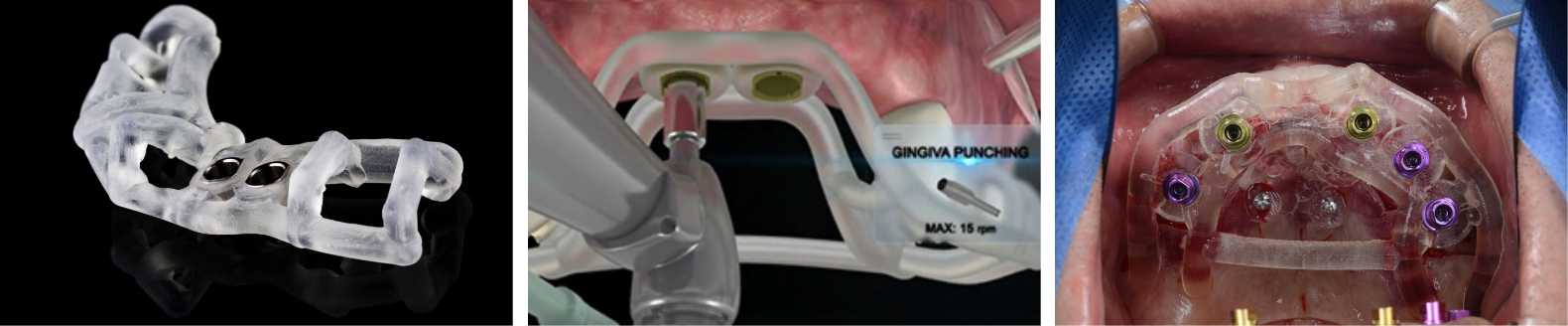 サイナスリフト(ラテラルアプローチ)
