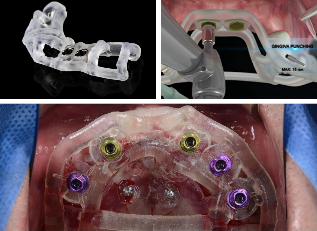 サイナスリフト(ラテラルアプローチ)